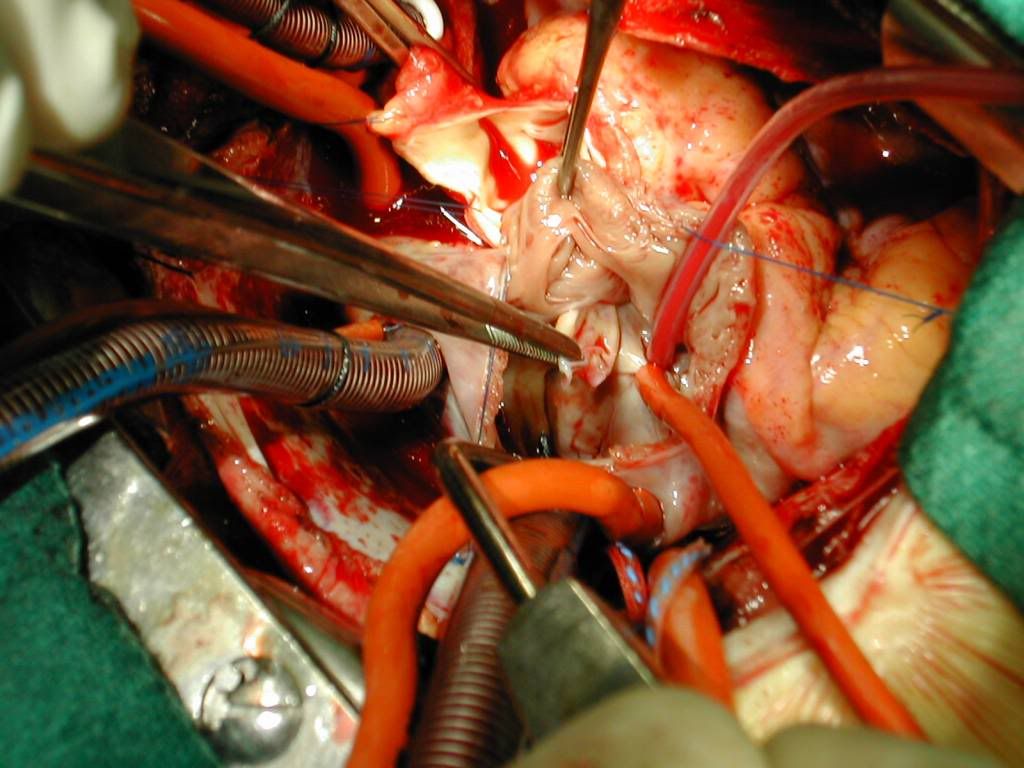 I gots the xiphoid process blues - NASIOC